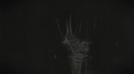  Xray